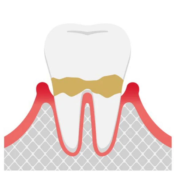 Illustration of a tooth with plaque below the gumline and early bone loss