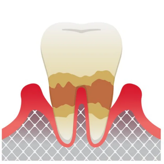 Illustration of a tooth with deep plaque and significant bone loss