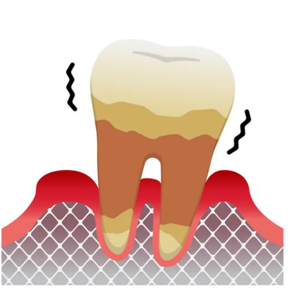 Illustration of a loose, decayed tooth with severe bone loss