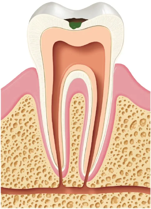 Tooth cross-section with a cavity in the enamel