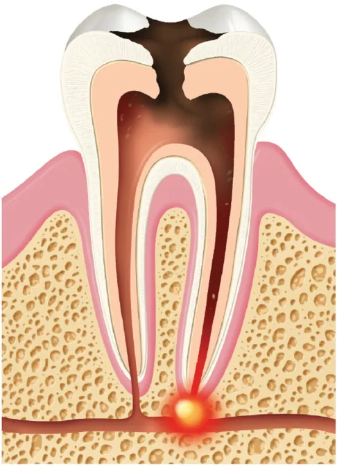 Tooth cross-section with an abscess at the root tip