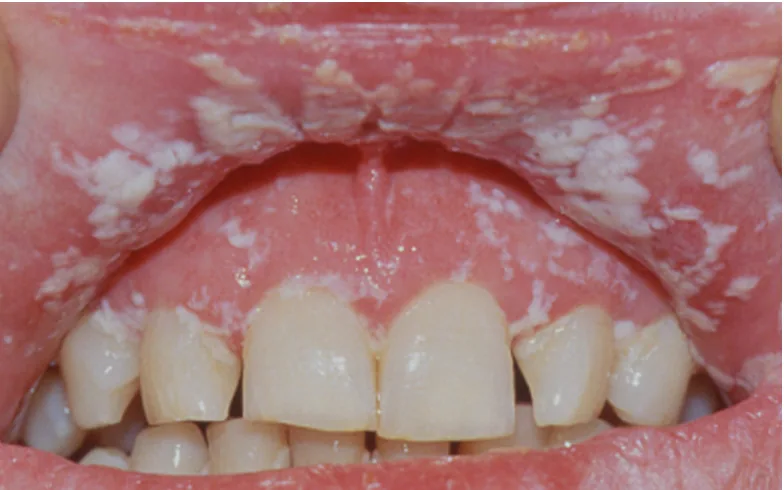 Creamy white candidiasis patches on the gums and palate