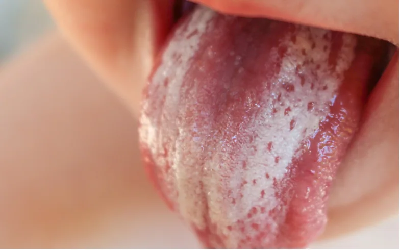 A tongue coated with white patches from a fungal infection