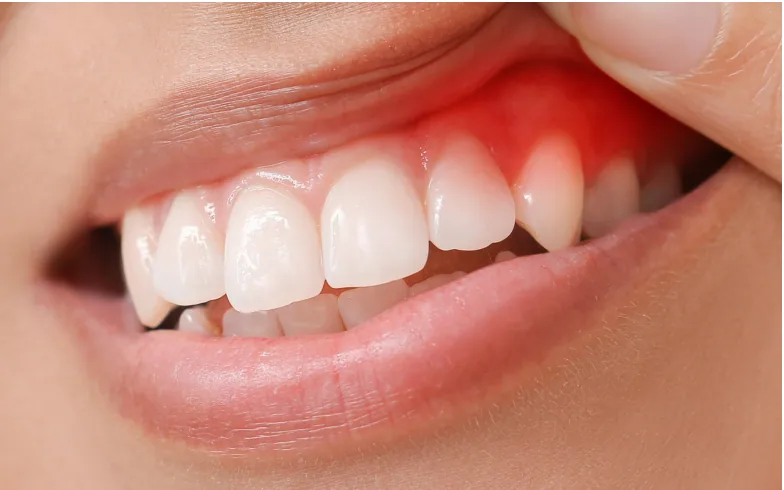 Red, inflamed gums above the upper front teeth