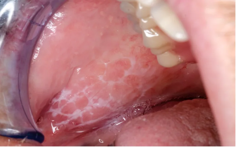 White lacy patches of lichen planus inside the cheek