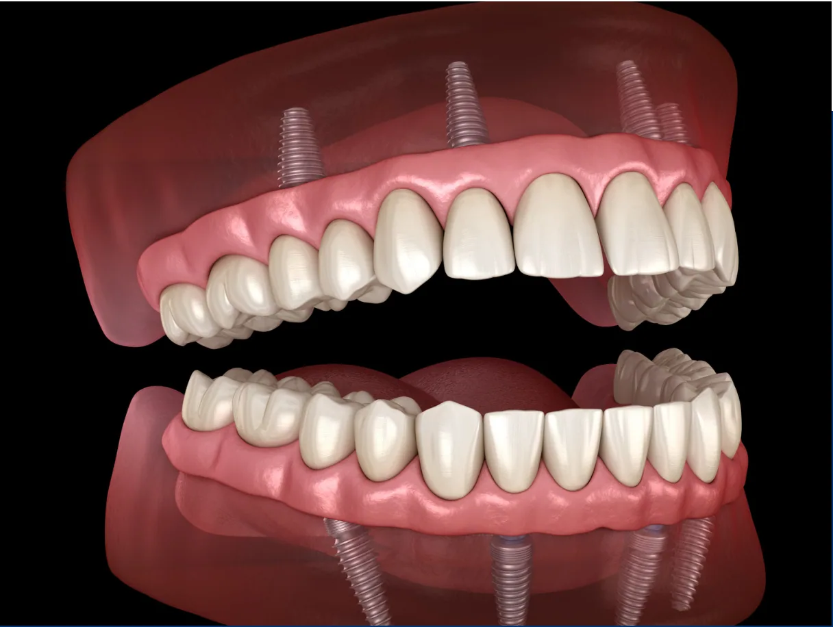 Illustration of a full-arch denture fixed onto four dental implants